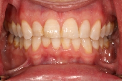a patient's straight and even teeth after clear braces