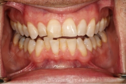 a patient's misaligned teeth before clear braces