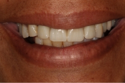 patient after with bright smile and straighter teeth