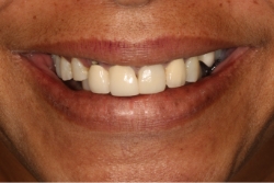 patient before dental implants with tooth decay and misaligned teeth
