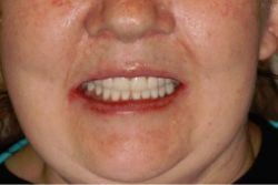 patient's smile after dentures